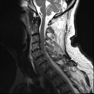 Apxe ngoài màng cứng