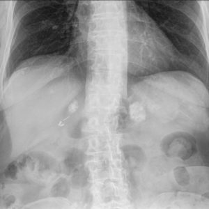 Vôi hóa tuyến thượng thận