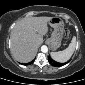 Túi thừa dạ dày