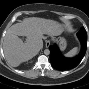 Túi thừa dạ dày