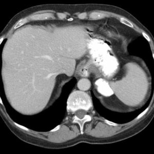 Túi thừa dạ dày