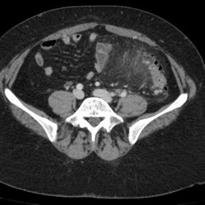 Viêm túi thừa đại tràng
