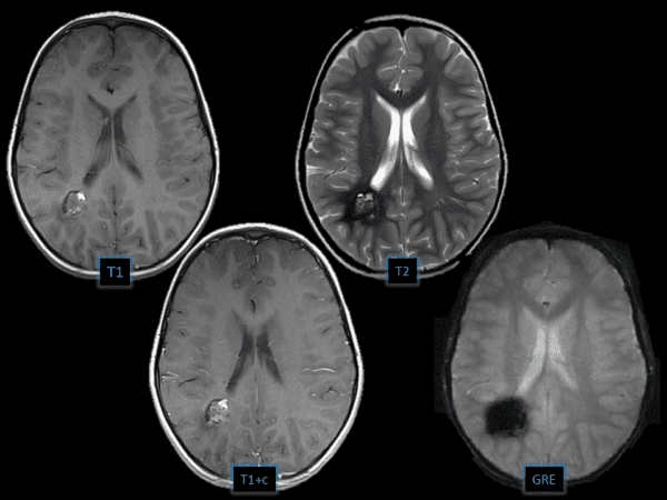 Cavernoma