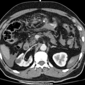 Chấn thương mạc treo