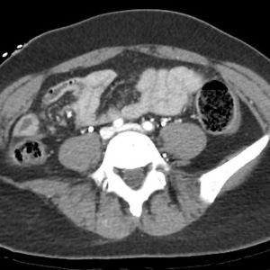 Chấn thương ruột non