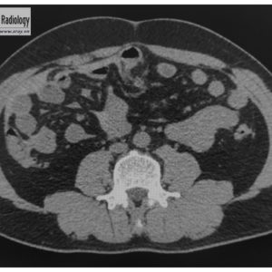 Chấn thương mạc treo