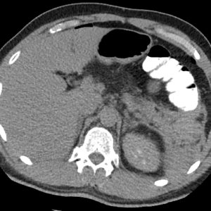 Chấn thương đại tràng