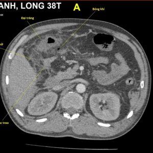 Chấn thương mạc treo ruột