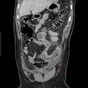 Chấn thương ruột