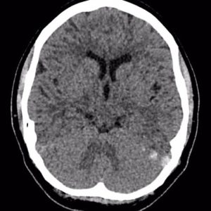 Huyết khối tĩnh mạch não