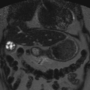 U cơ tuyến túi mật