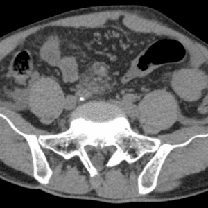 Chấn thương mạc treo