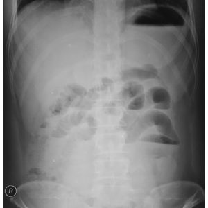 Thủng tạng rỗng