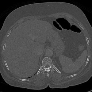 Vôi hóa màng cứng