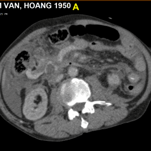 Chấn thương mạc treo ruột