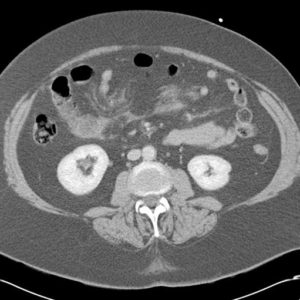Chấn thương mạc treo