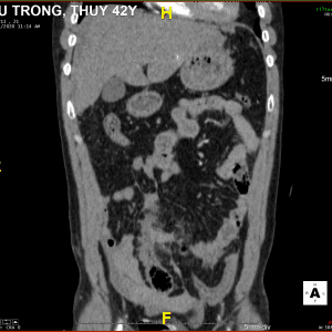 Chấn thương mạc treo - ruột