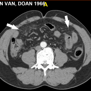 Chấn thương mạc treo ruột