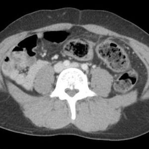 Chấn thương đại tràng
