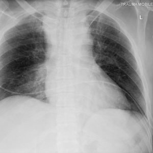 Chấn thương cột sống