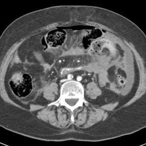 Chấn thương mạc treo