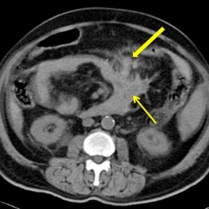 Chấn thương mạc treo