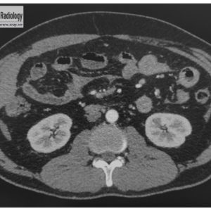 Chấn thương ruột