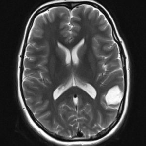 U nang thượng bì