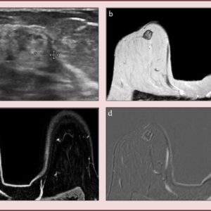 Hoại tử mỡ tuyến vú