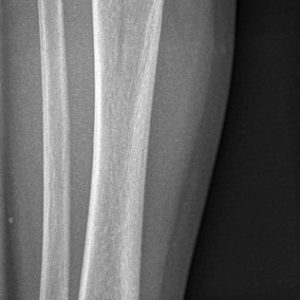 Gãy xương cẳng chân