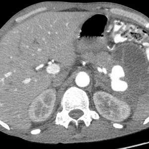 Giả phồng ĐM lách