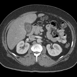 Viêm túi mật cấp