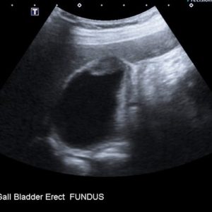 U cơ tuyến túi mật