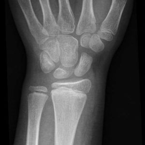 Chấn thương cẳng tay