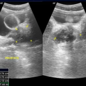 Apxe tiền liệt tuyến