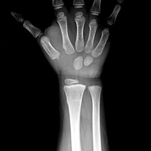 Chấn thương cẳng tay