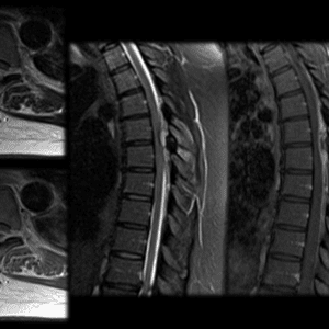 Apxe ngoài màng cứng