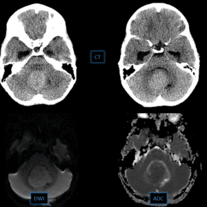 U nguyên bào tủy