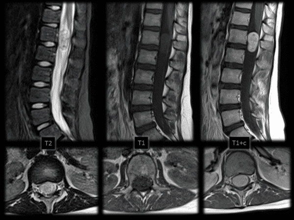 Schwannoma