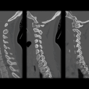 Chấn thương cột sống