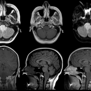 U thần kinh đệm thân não