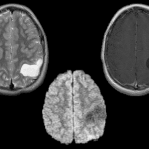 U hạch thần kinh đệm