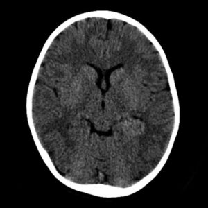 U đám rối mạch mạc