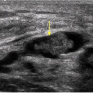 U nhú ống tuyến