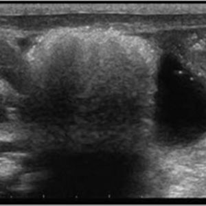 Viêm ruột hoại tử