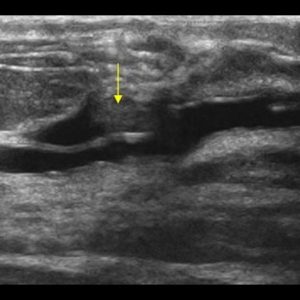 U nhú ống tuyến