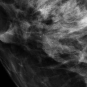 U nhú ống tuyến