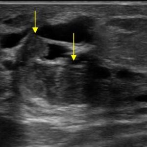 U nhú ống tuyến