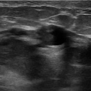 U nhú ống tuyến