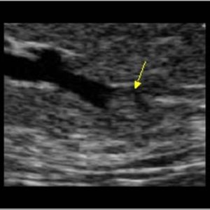 U nhú ống tuyến